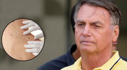 Jair Bolsonaro: ¿qué es el cáncer de piel, enfermedad que padece el expresidente de Brasil?
