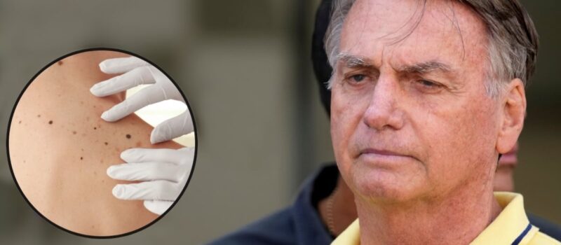 Jair Bolsonaro: ¿qué es el cáncer de piel, enfermedad que padece el expresidente de Brasil?