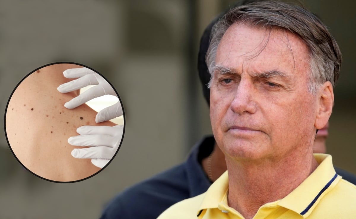 Jair Bolsonaro: ¿qué es el cáncer de piel, enfermedad que padece el expresidente de Brasil?