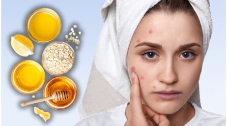Los mejores remedios caseros para eliminar las marcas de acné