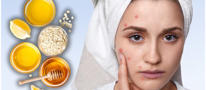 Los mejores remedios caseros para eliminar las marcas de acné