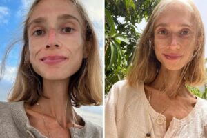 ¿Quién era Karolina Krzyzak, la joven vegana de 27 años que murió tras pesar 22 kilos?